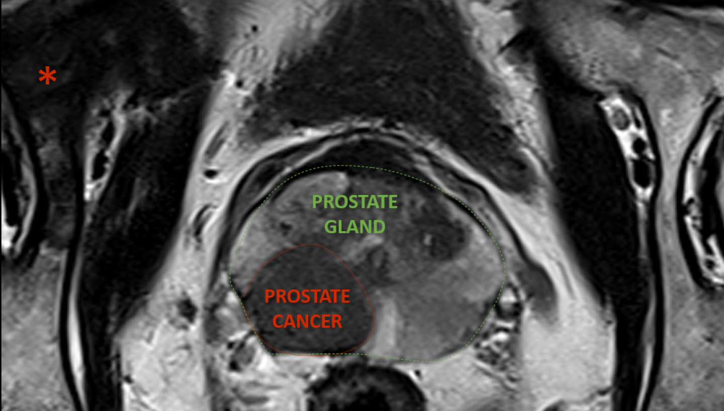 Prostate